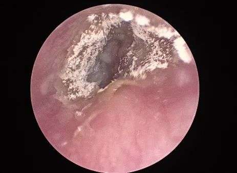 為什麼我的耳真菌感染治不好？