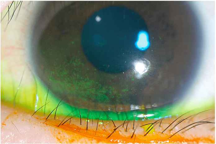 繼發於倒睫的角膜擦傷（圖源：AAO）