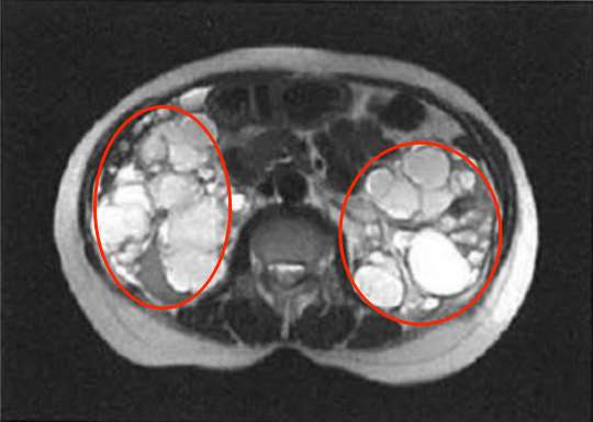 MRI顯示下的多囊腎☝