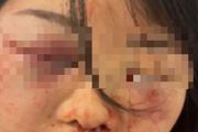 澳洲亞裔女遭入室搶劫，面部多處骨折，面目全非