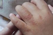 夏秋季，孩子最常見的皮膚病-沙土皮炎