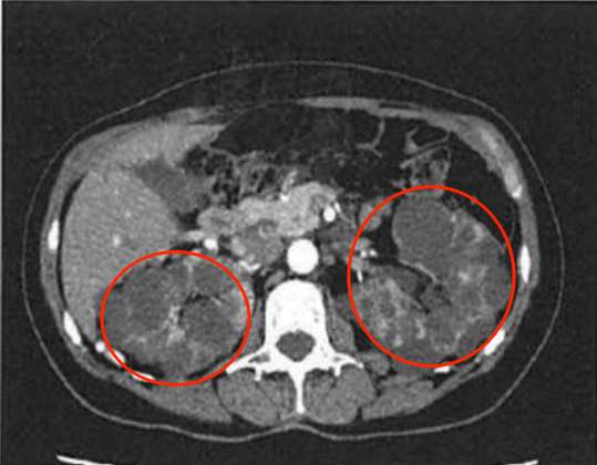 CT顯示下的多囊腎☝