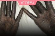 接受治療後，手掌竟變成「黑炭」，原因是什麼？