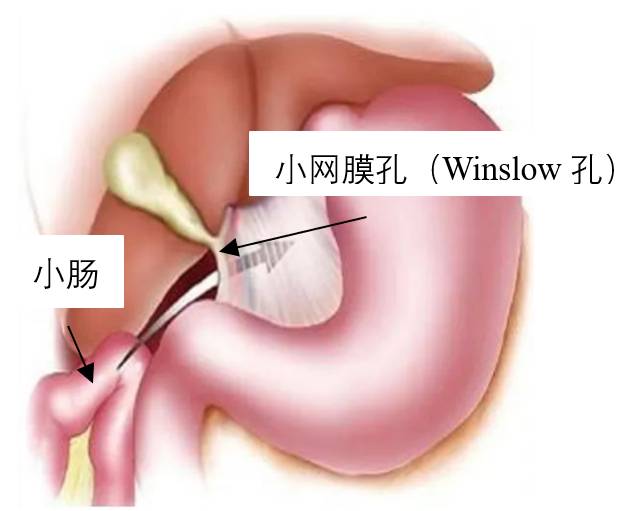 盲腸周圍疝：腸管嵌入盲腸後間隙