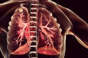 肺部結節（腫塊）≠ 肺癌，出現這些症狀需要高度警惕肺癌