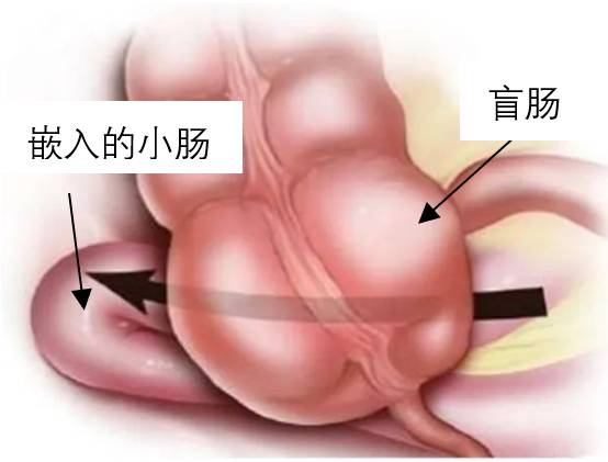 盲腸周圍疝：腸管嵌入盲腸後間隙
