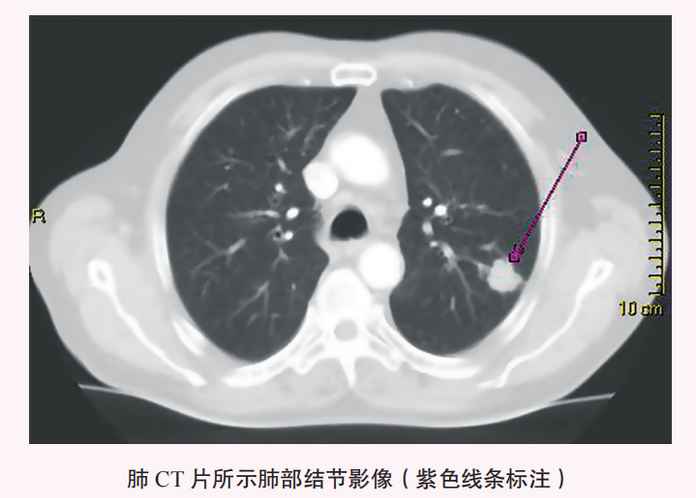 發現肺部結節（腫塊）一定是肺癌嗎？