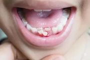 孩子牙齦出血不能掉以輕心，問題可大可小