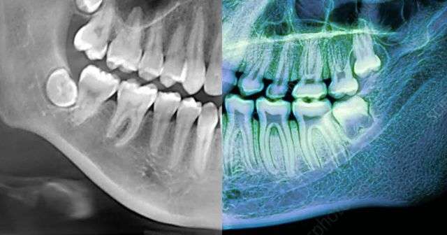 請問人類，能找出哪個是我的牙齒X線片不？