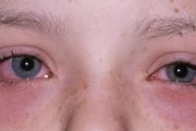 揉眼睛是過敏性結膜炎嗎？如果是怎麼處理呢？
