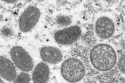 日本發現首例猴痘患者！外務省發佈全球一級旅行警告,千葉手足口病爆發