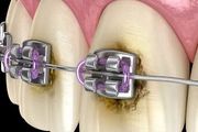 種植牙、正畸「鋼牙」、固定橋怎麼用牙線？