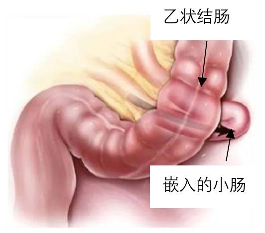 乙狀結腸周圍疝：腸管嵌入乙狀結腸後間隙