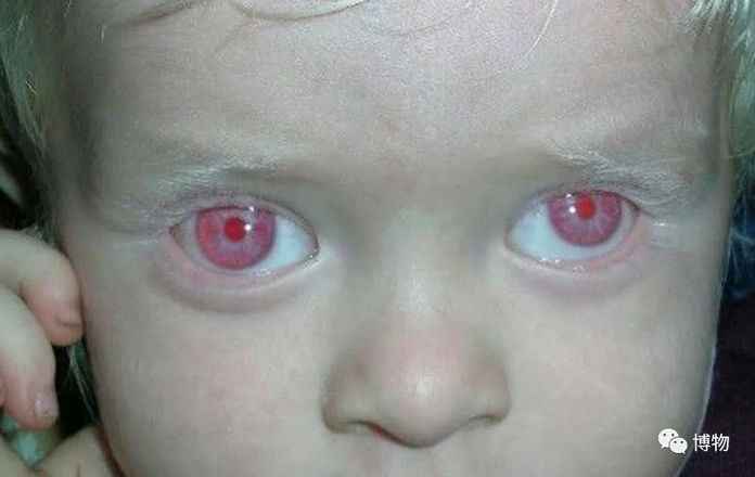 白化病患者的眼睛